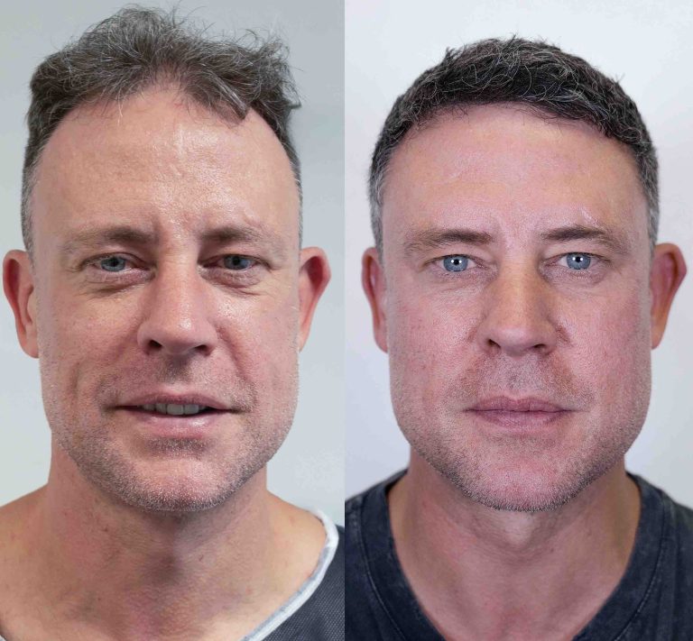Wayne Bridge shows off the incredible results of his £7,000 hair transplant at DHI Global in London and says: “I’m buzzing.” Wayne Bridge shows off the incredible results of his £7,000 hair transplant at DHI Global in London and says: “I’m buzzing.”
